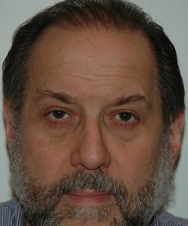 After: restored frontal hair, front view