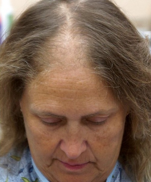 Before: thinning hair with widened part