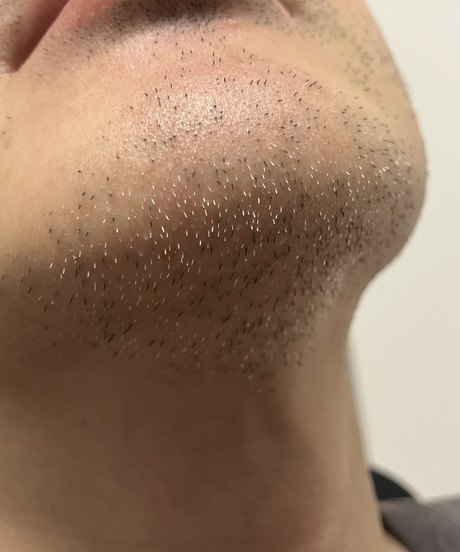 Before: sparse stubble on chin and jaw